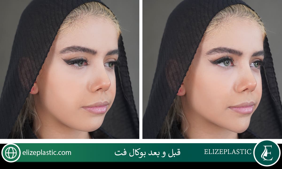 قبل و بعد بوکال فت